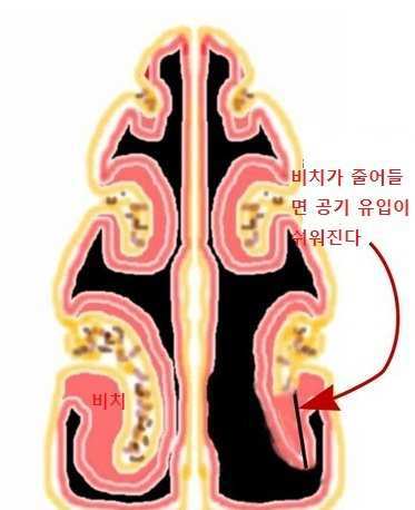 비염치료